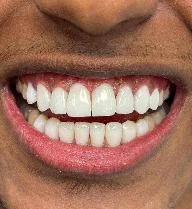 After composite bonding treatment