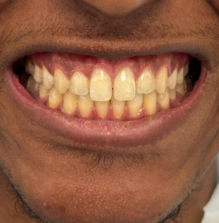 Before composite bonding treatment