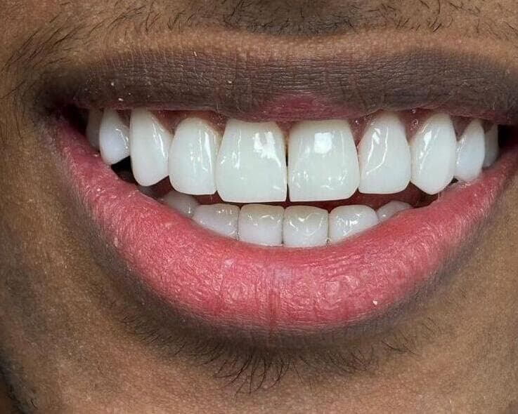 Composite bonding candidate — gap closure result