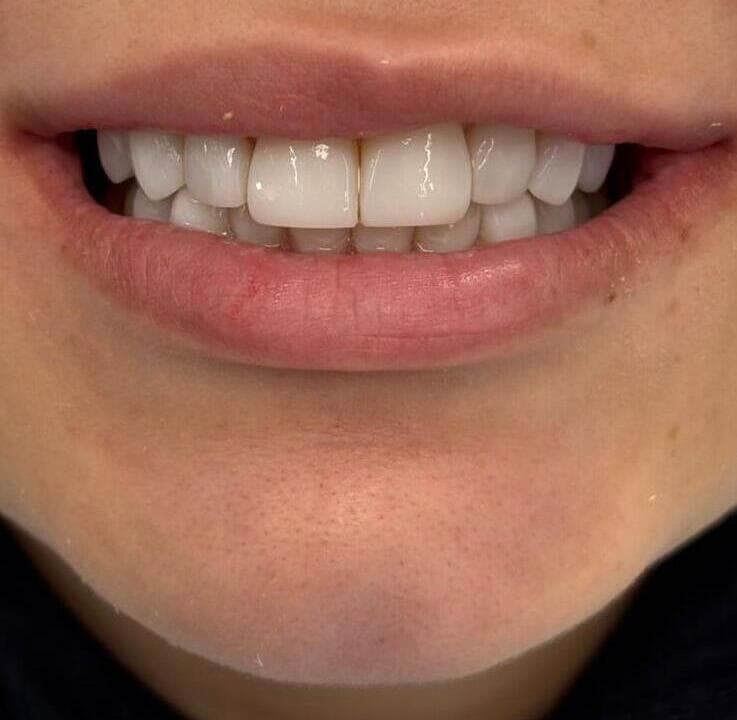 Composite bonding same-day result at Cellavia Dental