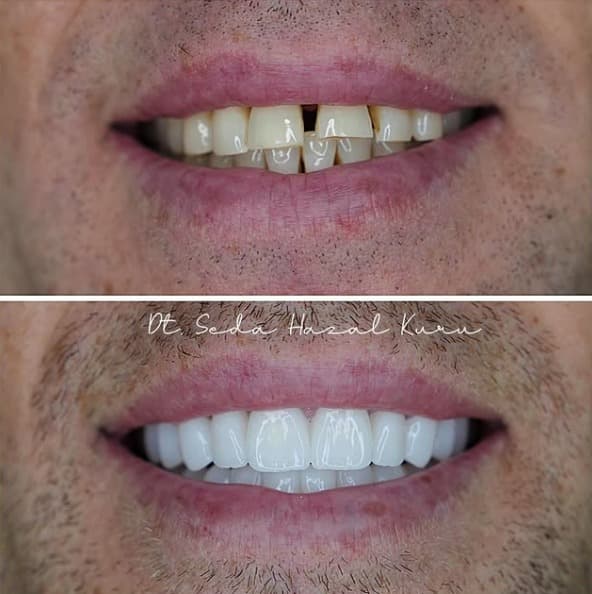 Bone Graft Before Dental Implants: What to Expect