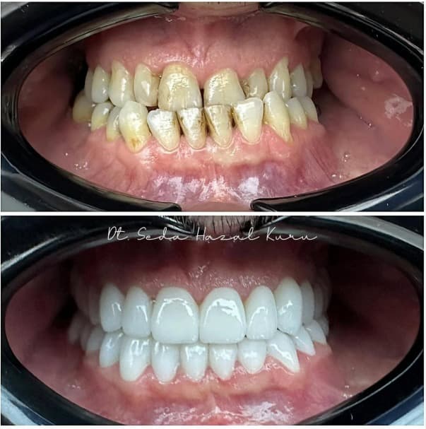 Is Dental Implant Treatment Safe for Smokers?