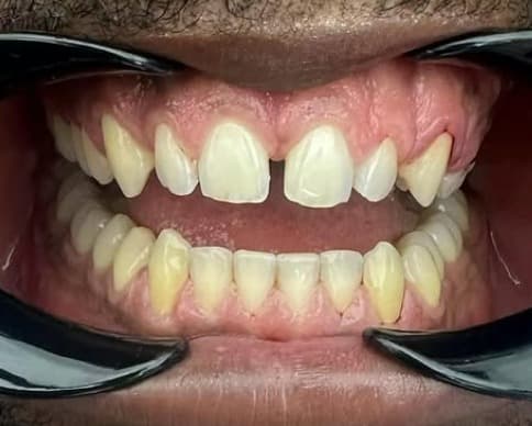 All-on-4 vs Zirconia Bridge: Which Option Fits Your Case?