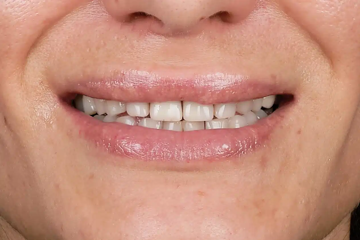 Can You Get Dental Implants If You Have Gum Disease?