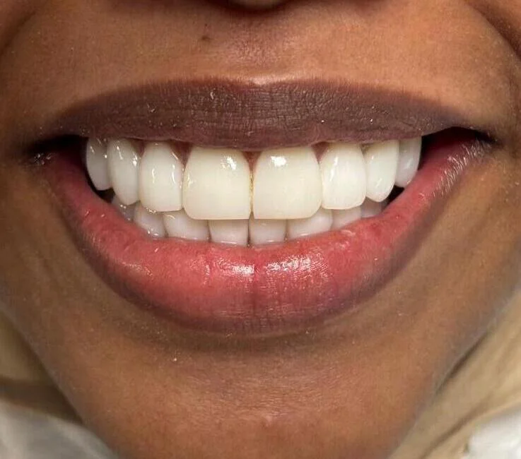 Bonding treatment after photo for case 1