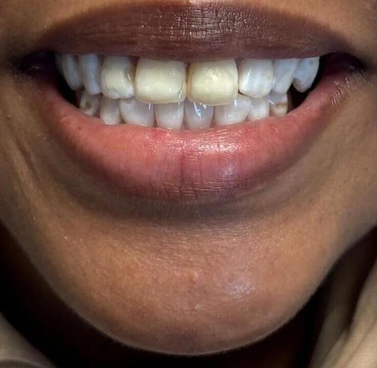 Bonding treatment before photo for case 1