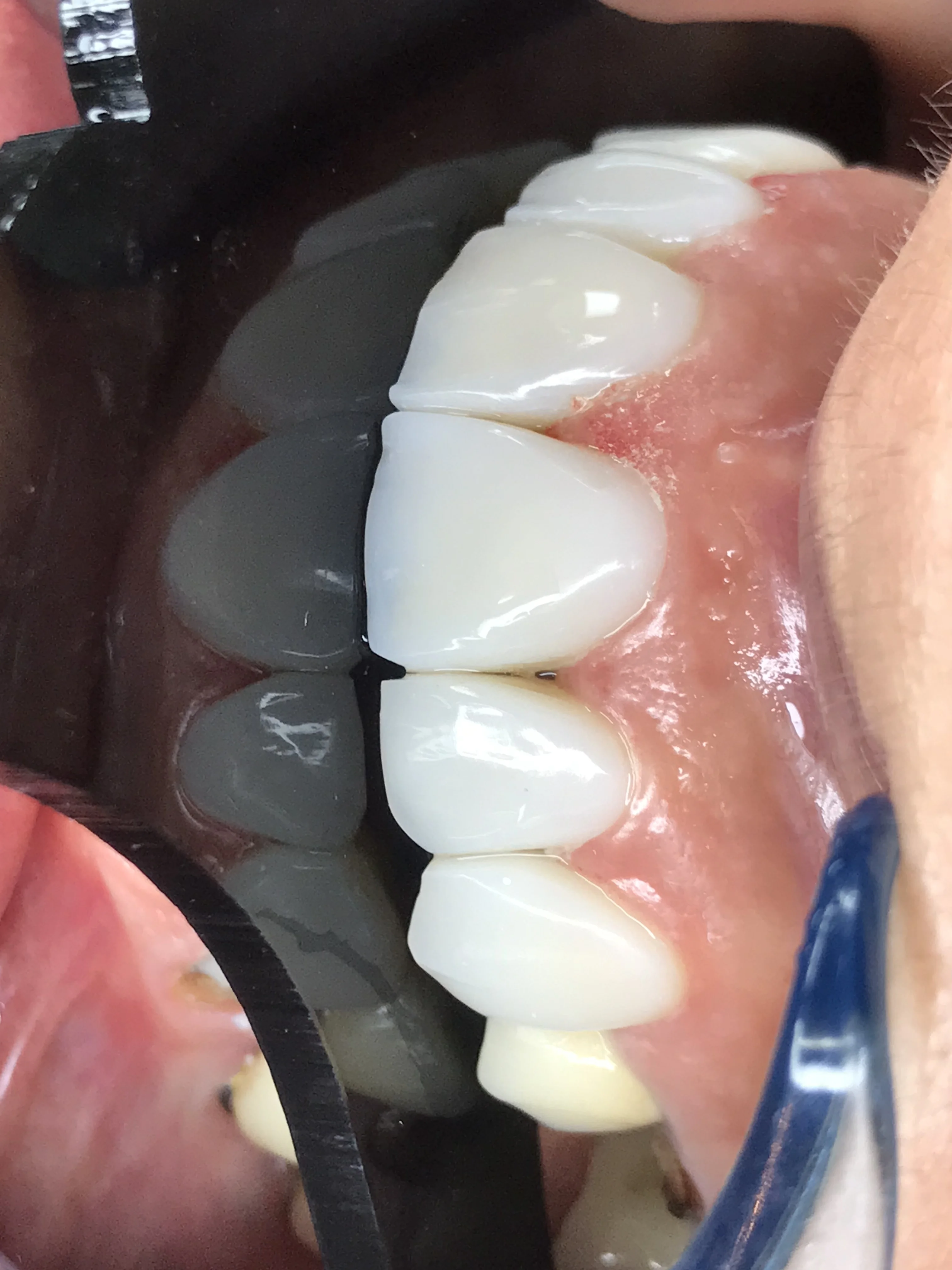 Before: edentulous jaw, severe bone loss