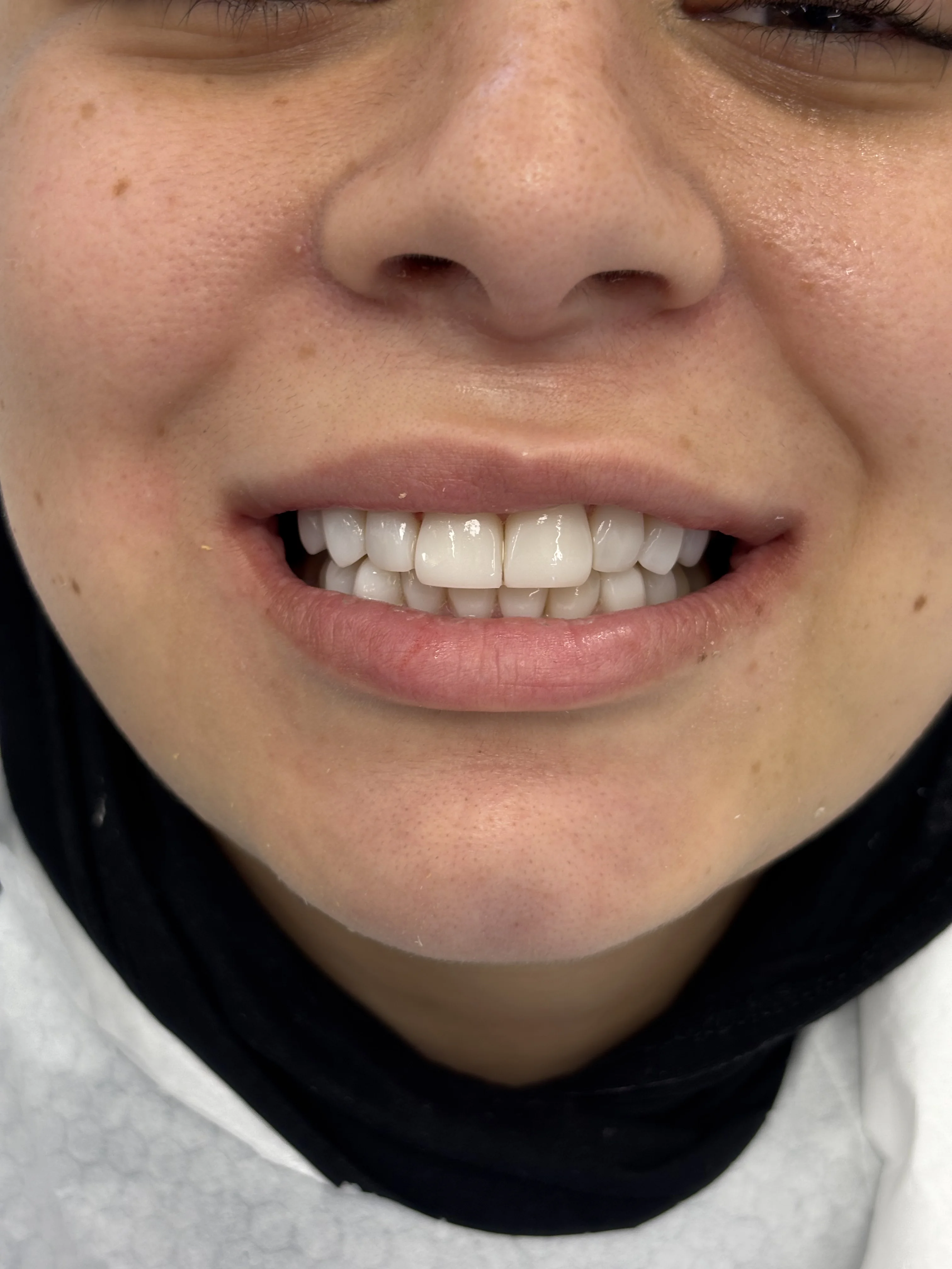 After: full mouth fixed bridge