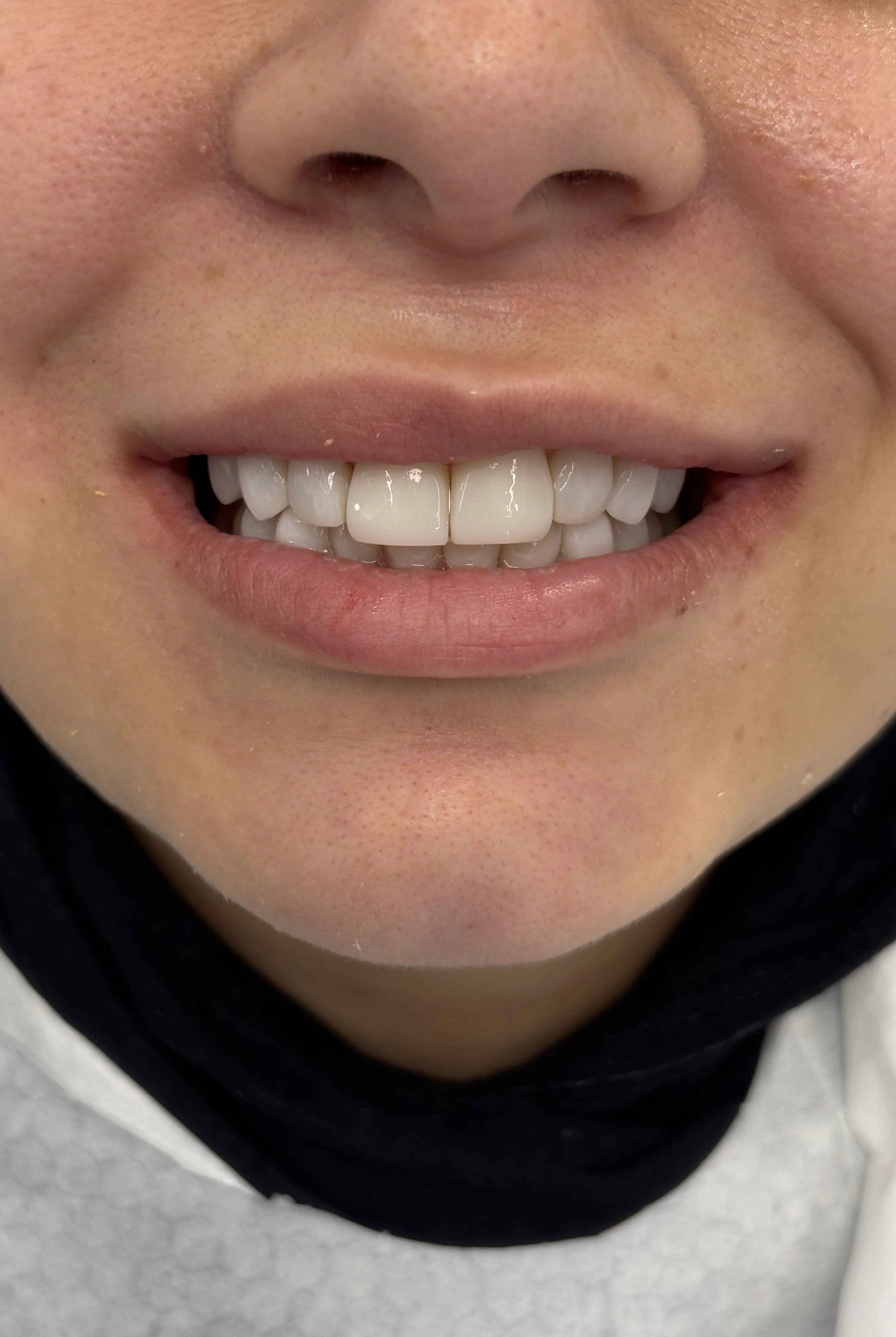 Before: partial tooth loss, compromised smile