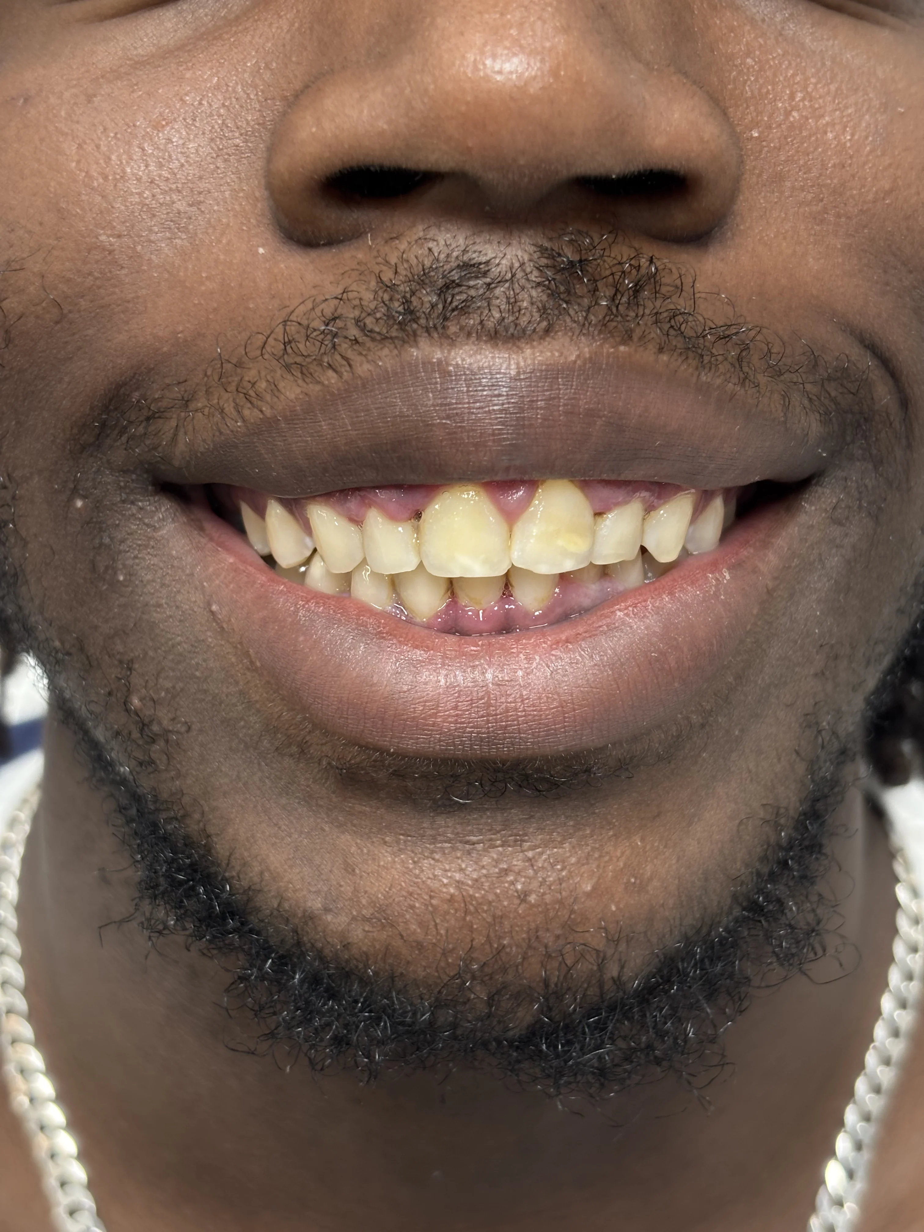 After: restored jaw function and aesthetics