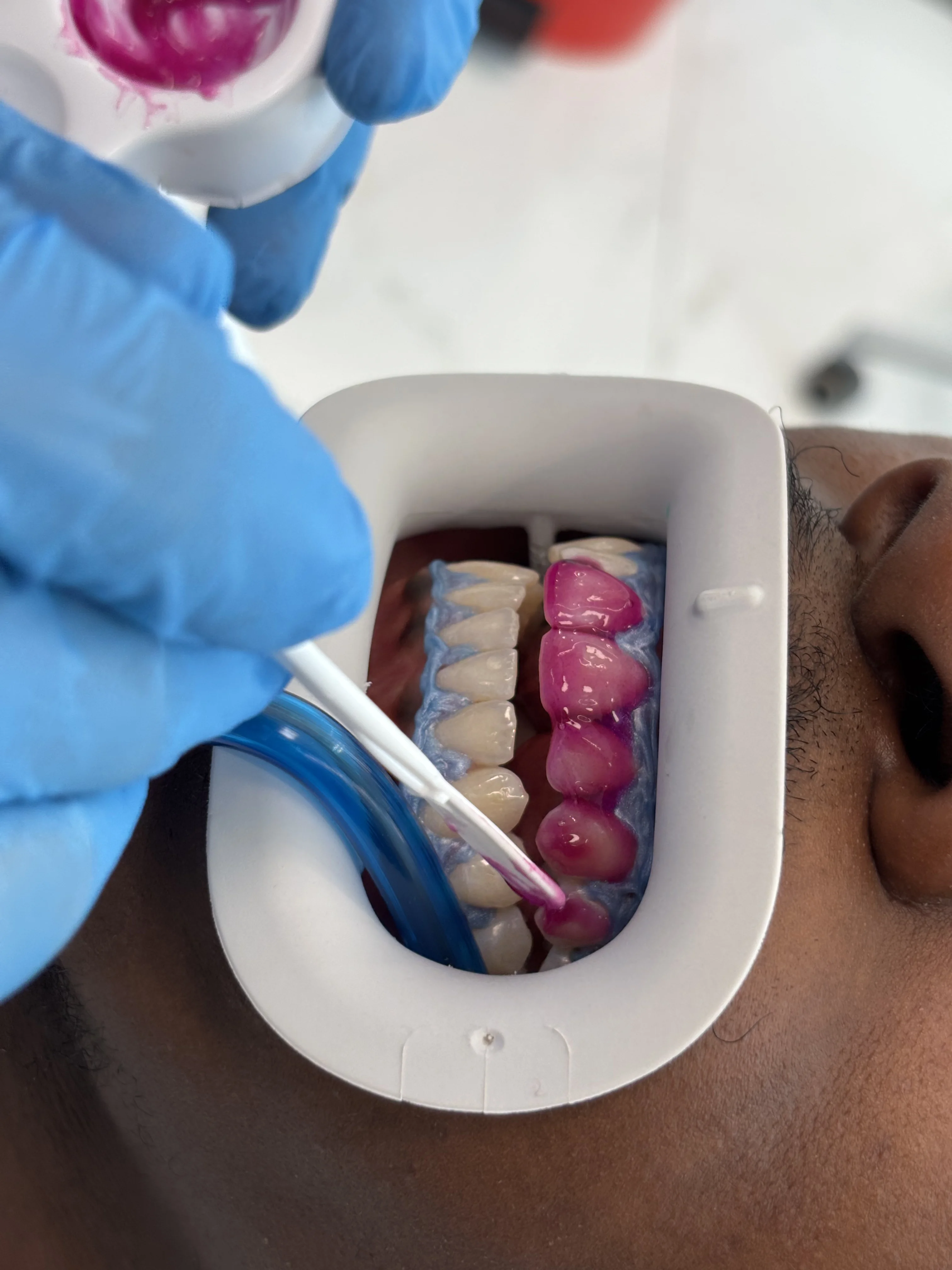 After: immediate teeth on same day
