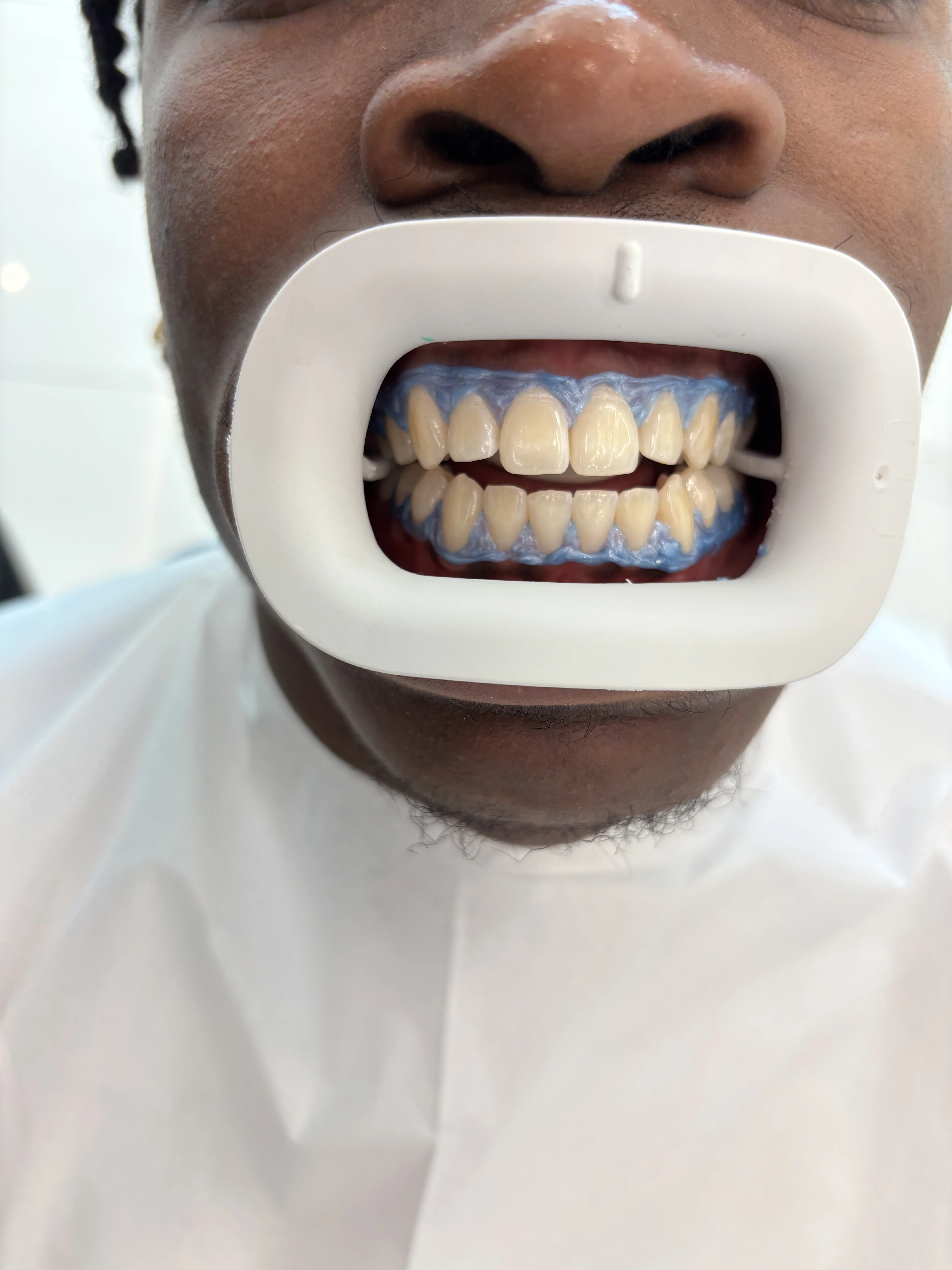 Before: failing natural teeth