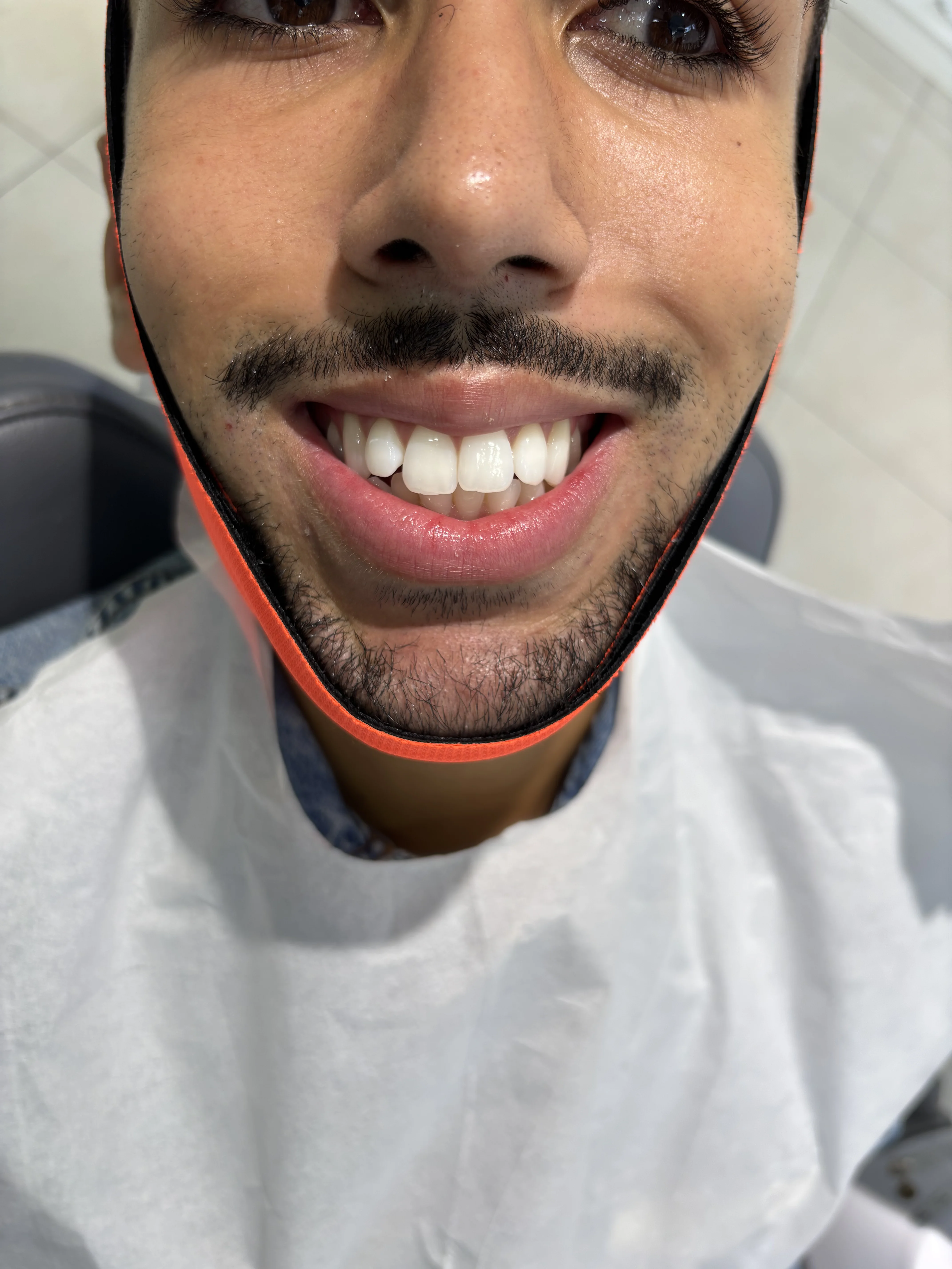 Before: inadequate bone for conventional implants