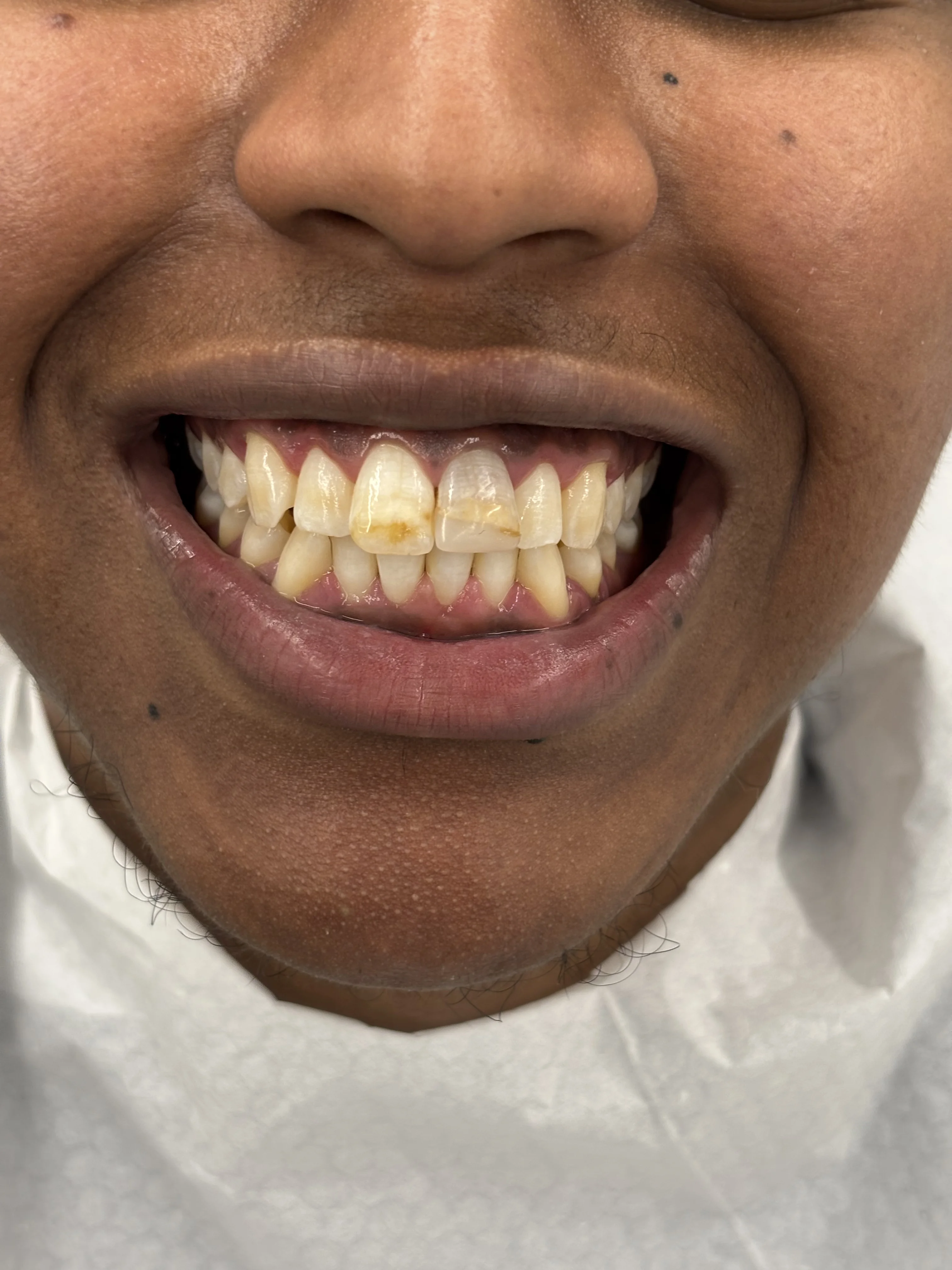 After: zygomatic solution providing stability