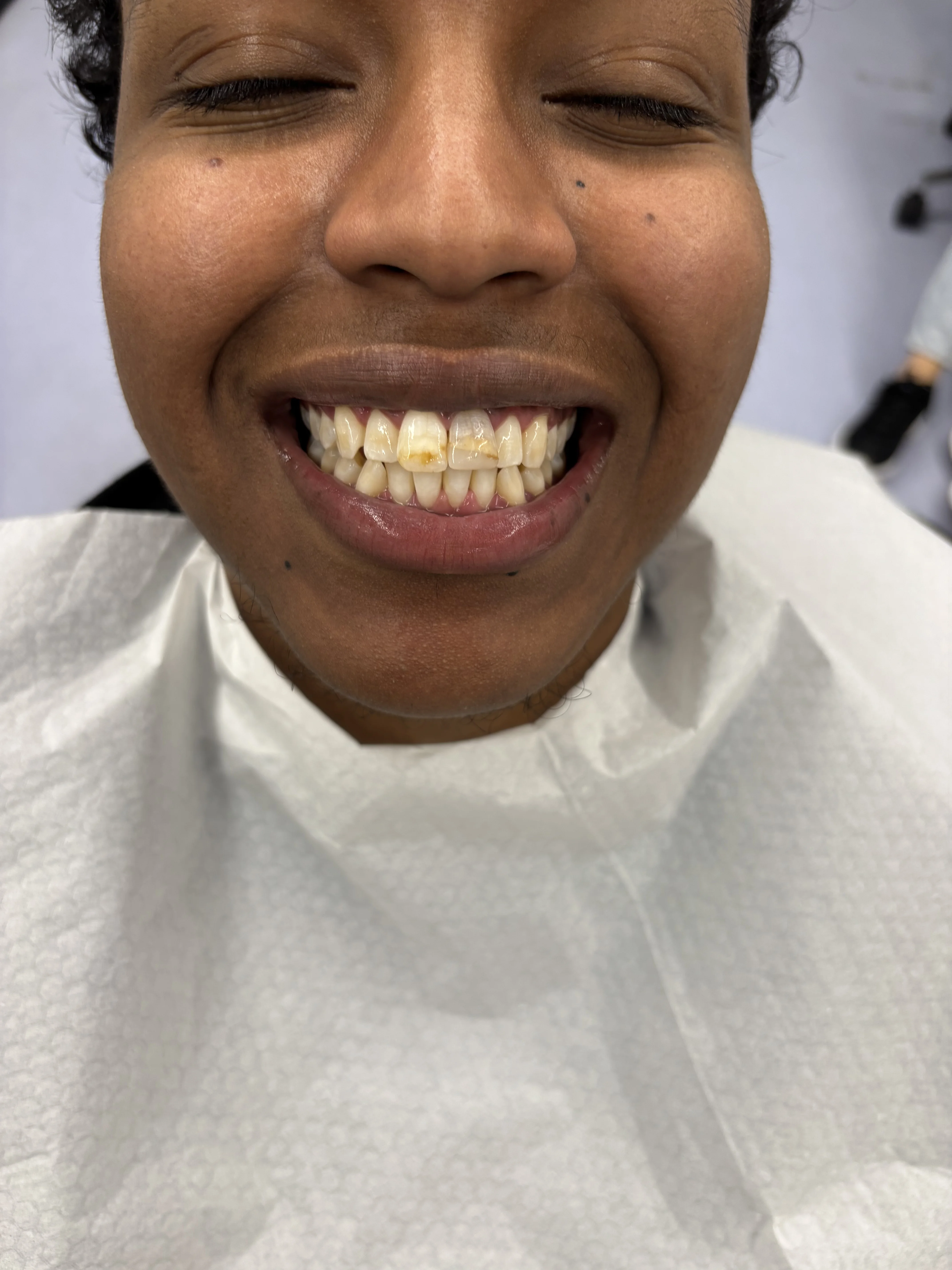 Before: failed previous implant treatment