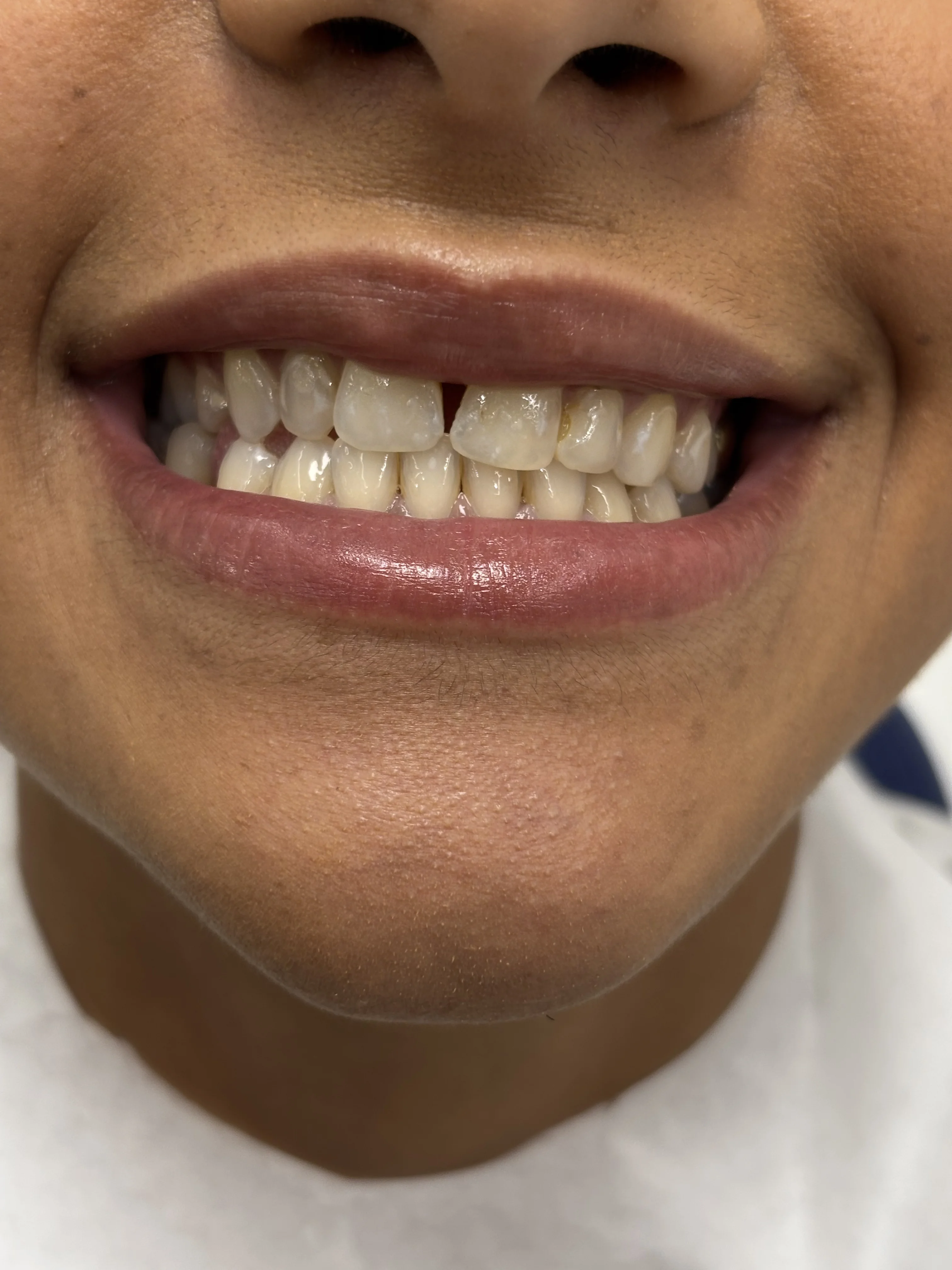 After: bright, natural-looking smile