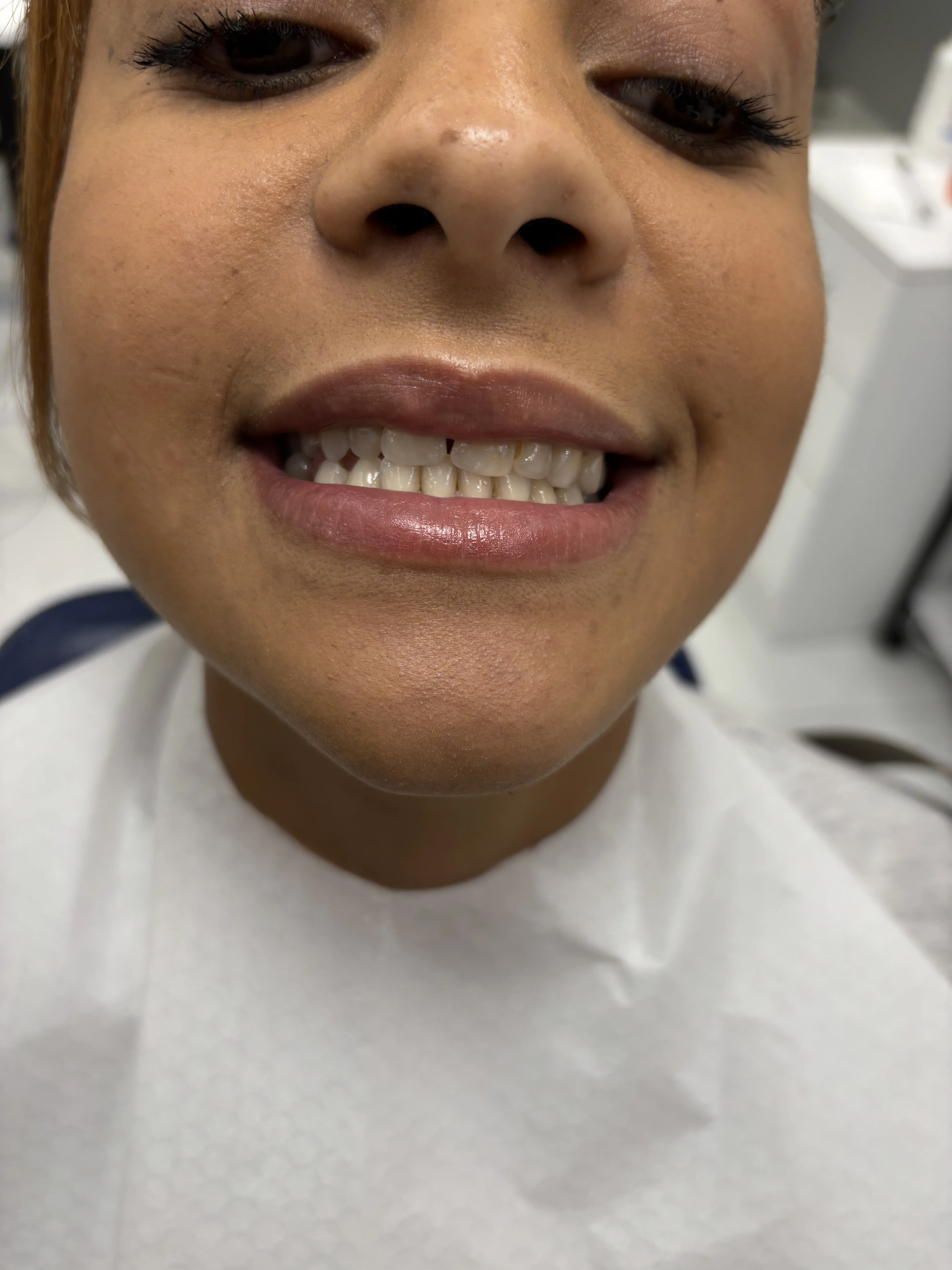Before: stained, discolored teeth