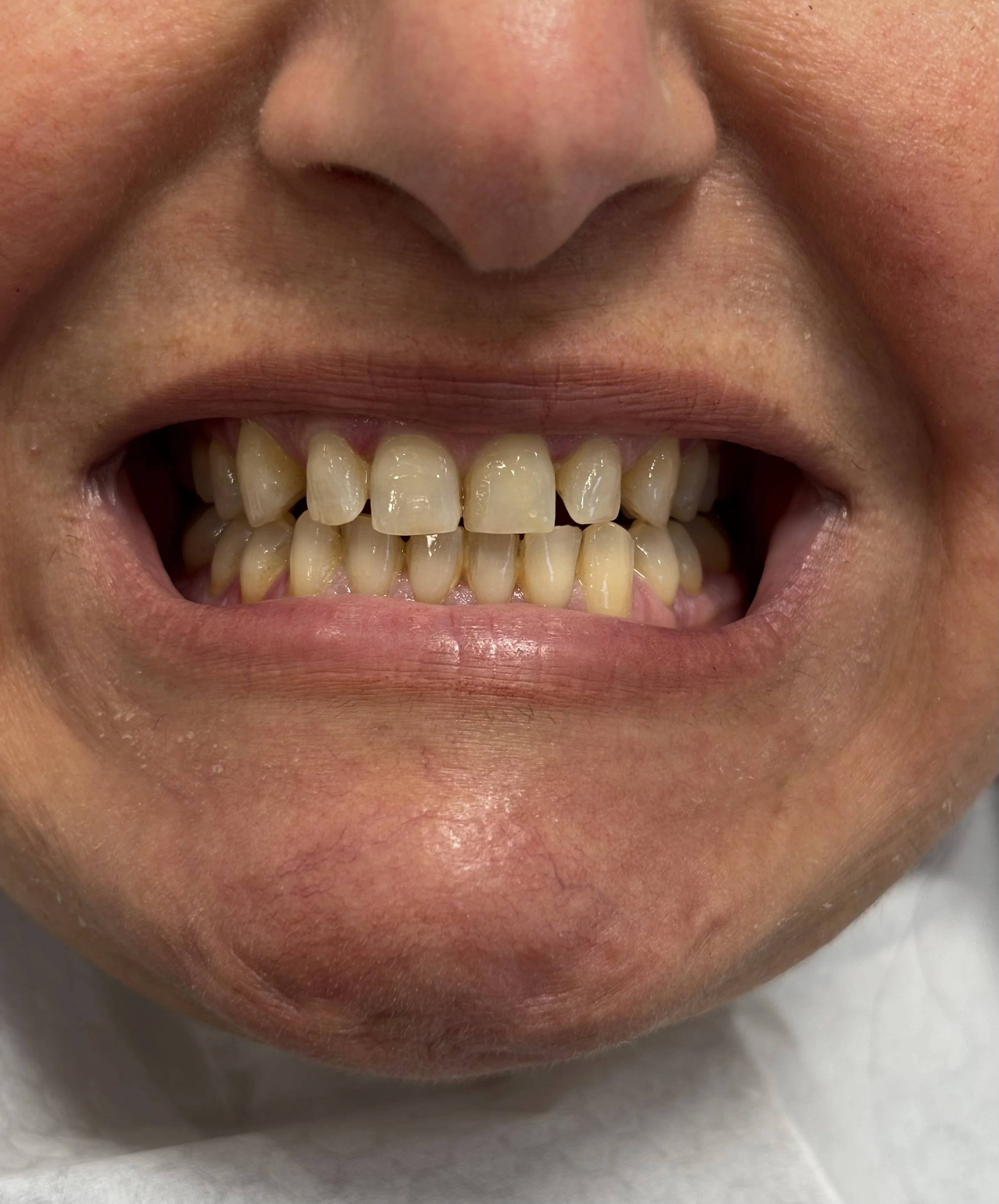 After: proportional, harmonious smile