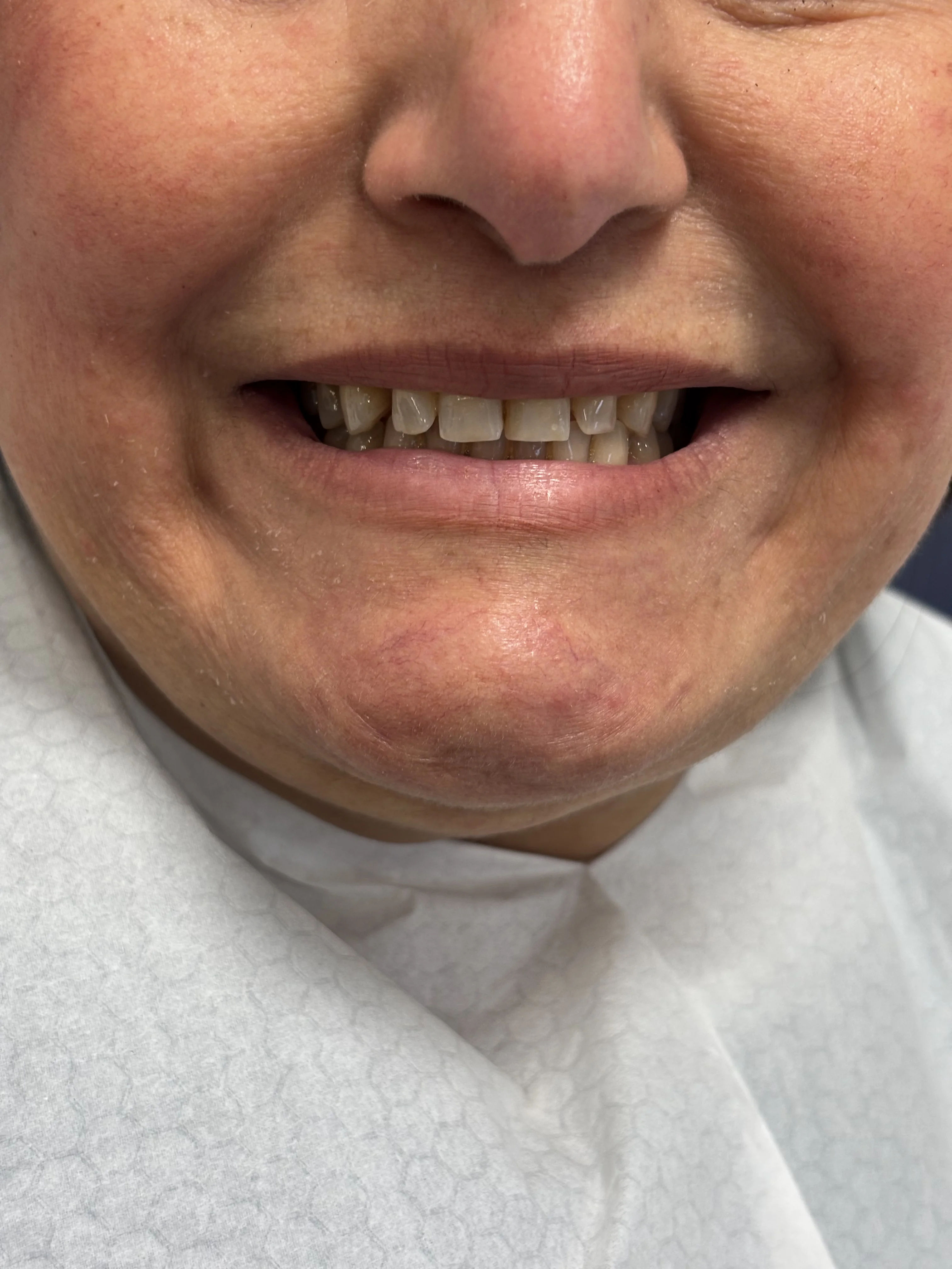 Before: uneven, worn teeth