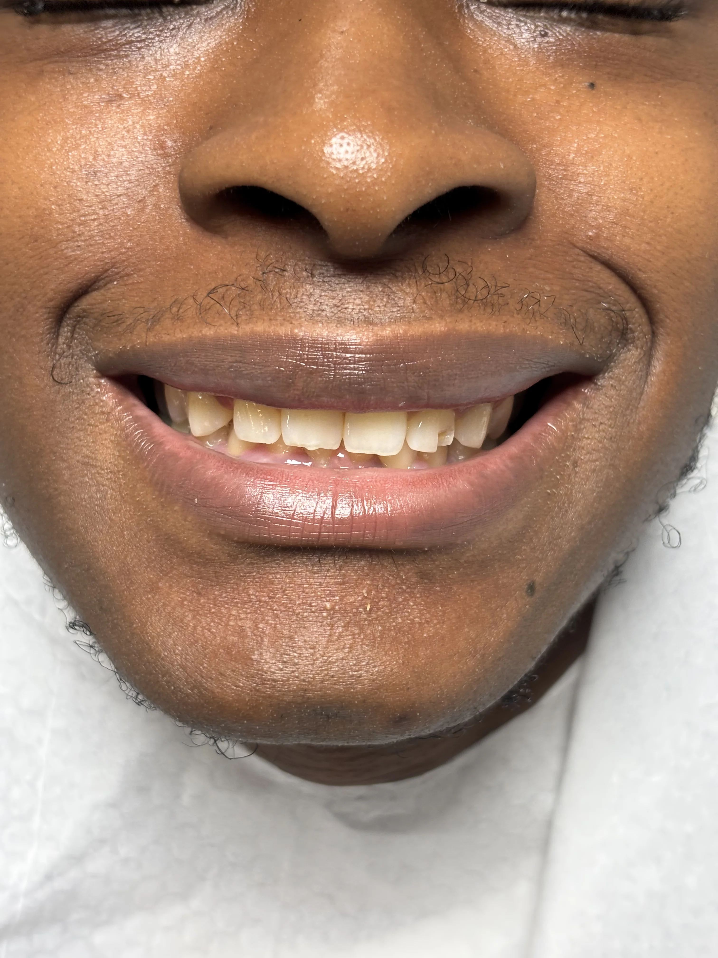 After: complete smile transformation