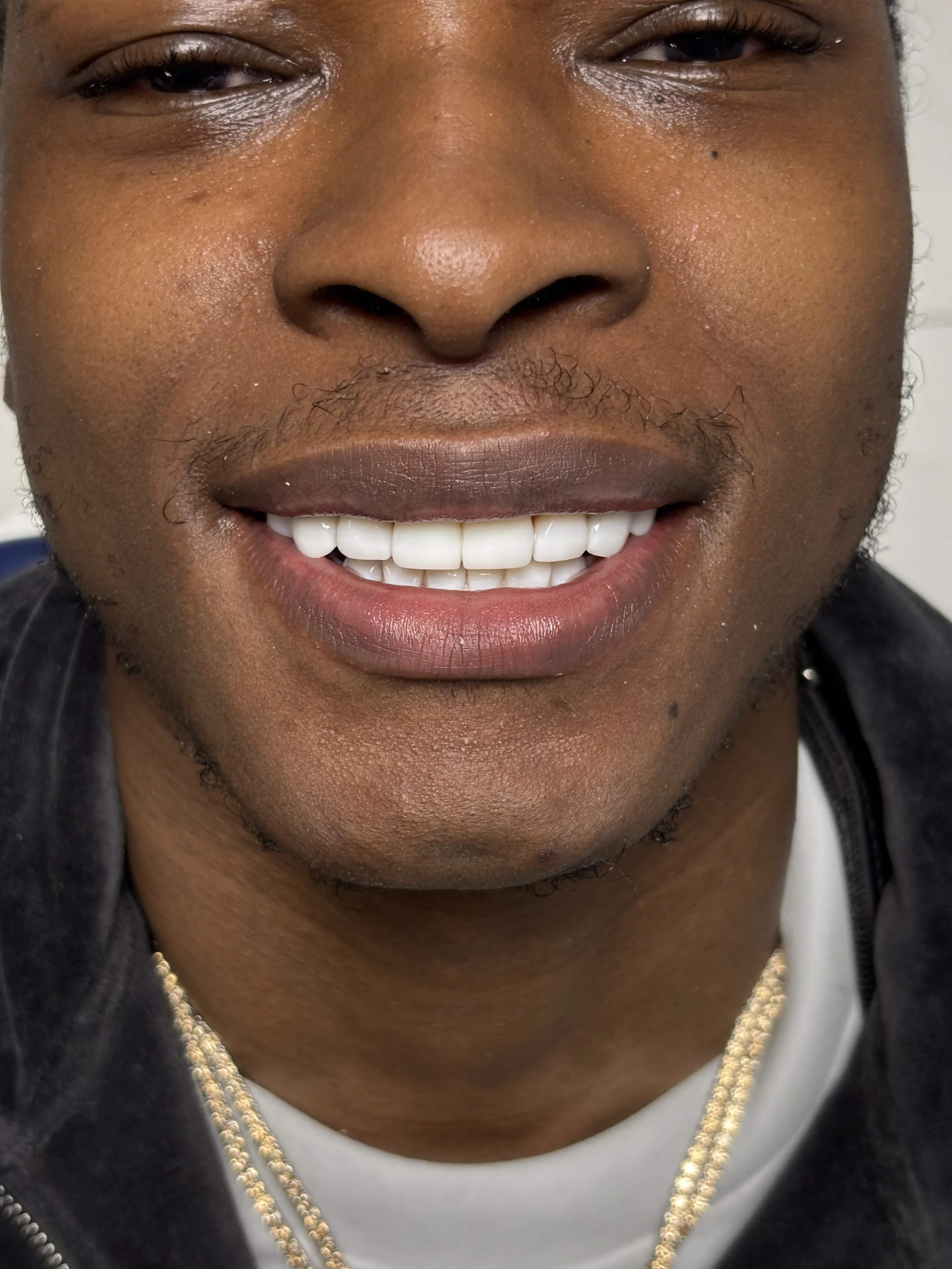 Before: chipped, broken tooth