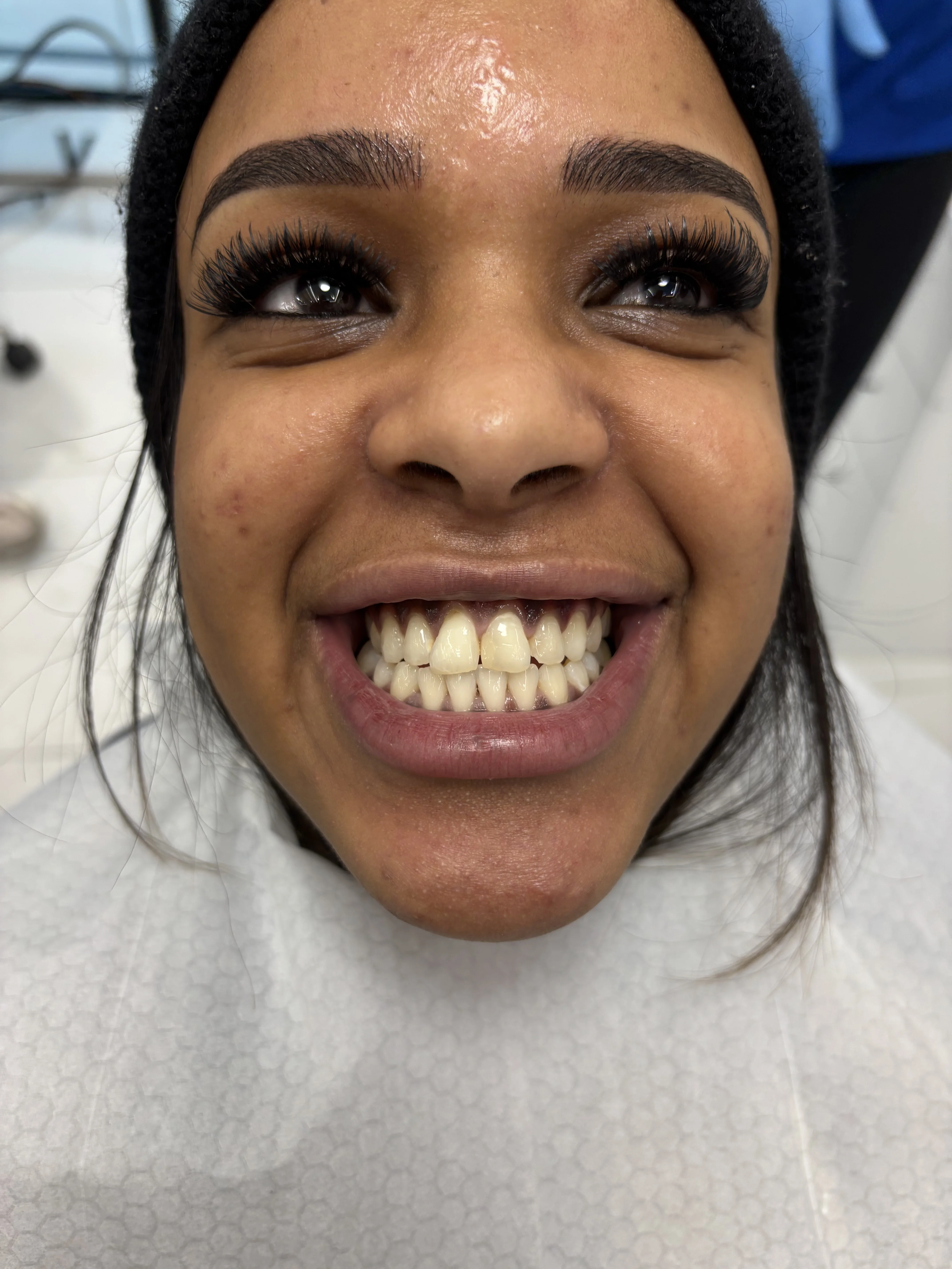 Before: wide diastema between teeth