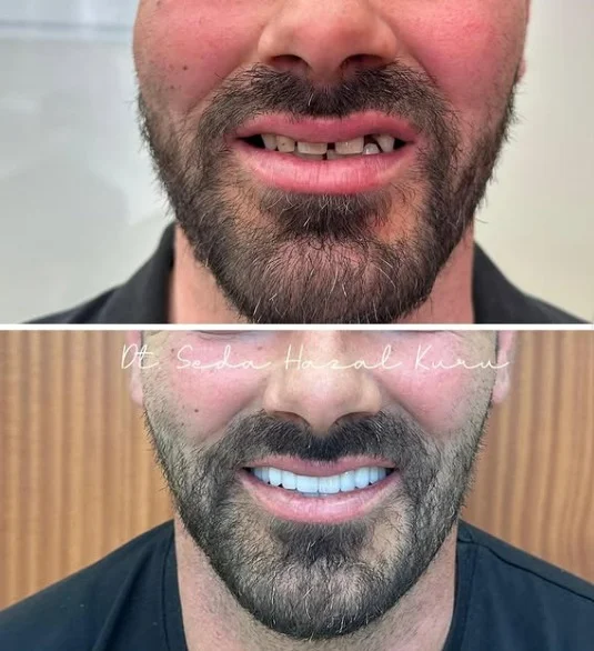 Professional Teeth Whitening: How Long Do Results Last?