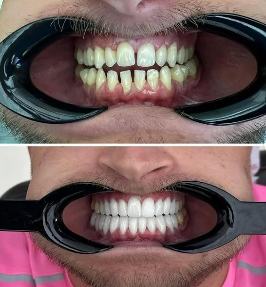 Prosthodontic smile restoration before and after case 2 by Dt. Seda Hazal Kuru at Cellavia Dental, Istanbul