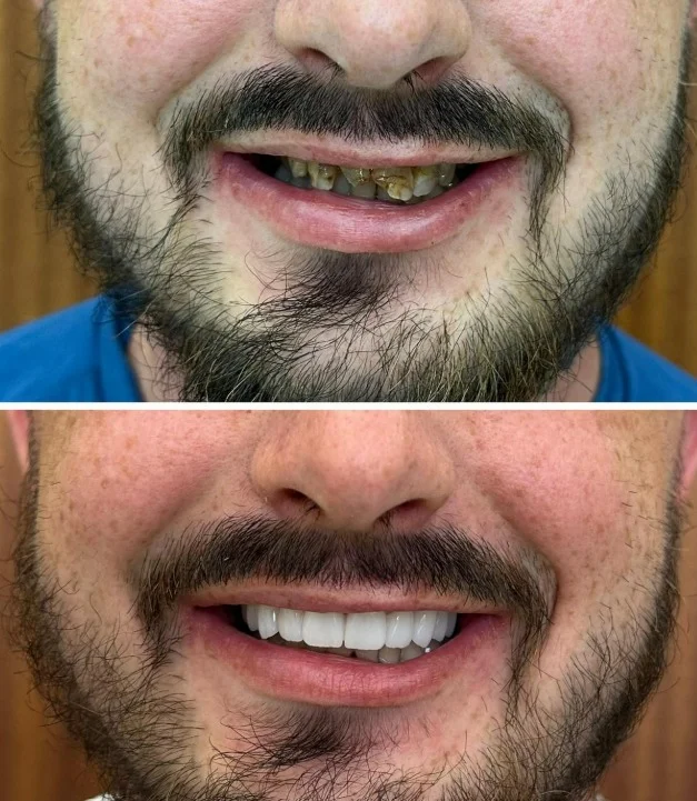 How Long Do All-on-4 Implants Last?